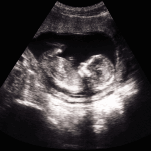 The SLED Argument - When Does Life Begin?